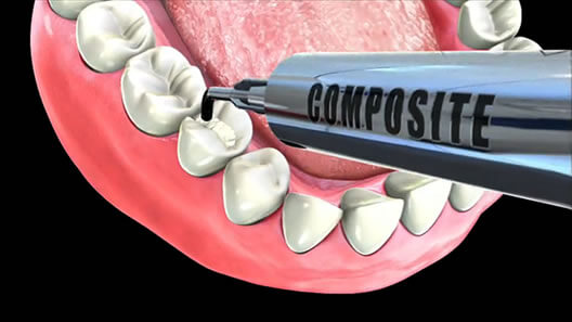 composite-filling