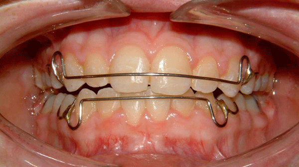 Orthodontic retainers