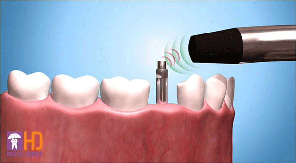 nhakhoa-implant