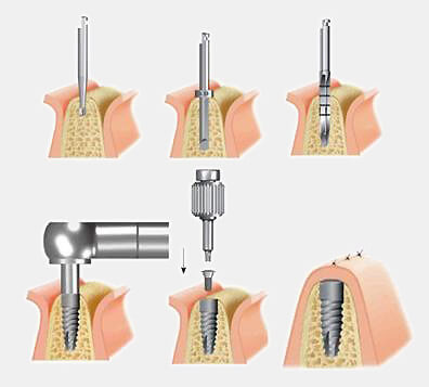 quy-trinh-implant-phau-thuat