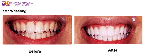 teeth-whitening