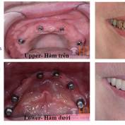 All-On-4 and All-On-6 for complete edentulous arch