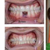Implant and prosthesis for anterior teeth