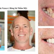 Implant and prosthesis for anterior teeth