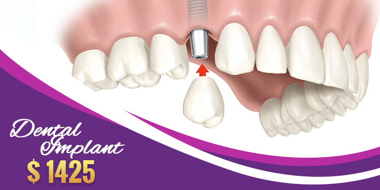 Dental Implant